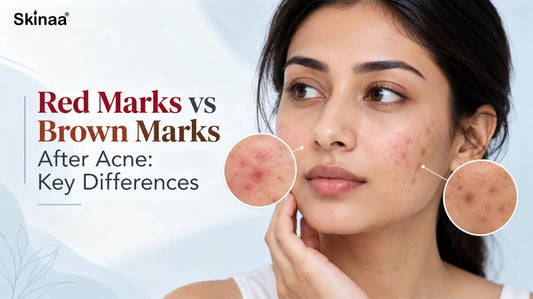Red Marks vs Brown Marks After Acne: Key Differences