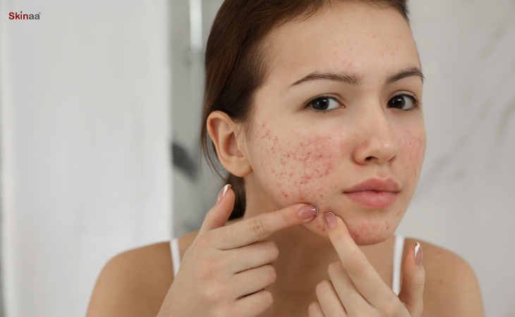 Top 10 Acne Myths Resolved For You