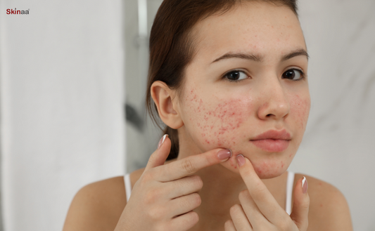 Top 10 Acne Myths Resolved For You