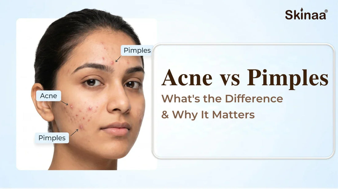 Acne vs pimples what's the difference between & why it matters