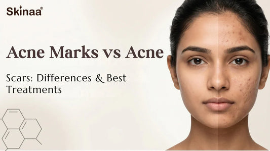 acne marks vs acne scars
