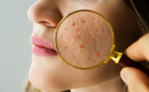 Combatting Summer Acne: Tips for Managing Oily Skin in Heat