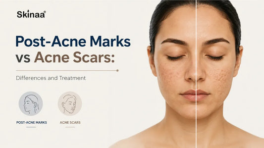 Post-Acne Marks vs Acne Scars: Differences and Treatment