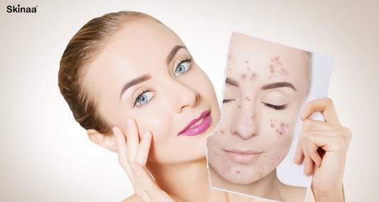 Best Strategies To Get Acne-Free Skin