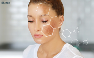 How to get rid of the Dark Circles?