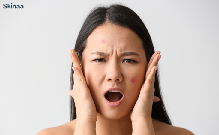 How to Remove Pimple Marks Naturally?