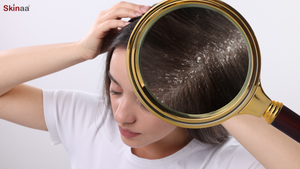 Say Goodbye to Dandruff with Skinaa Anti-Dandruff Shampoo