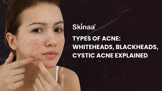 Types of Acne: Whiteheads, Blackheads, Cystic Acne Explained