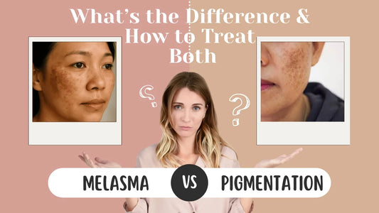 Melasma vs Pigmentation: What’s the Difference & How to Treat Both?