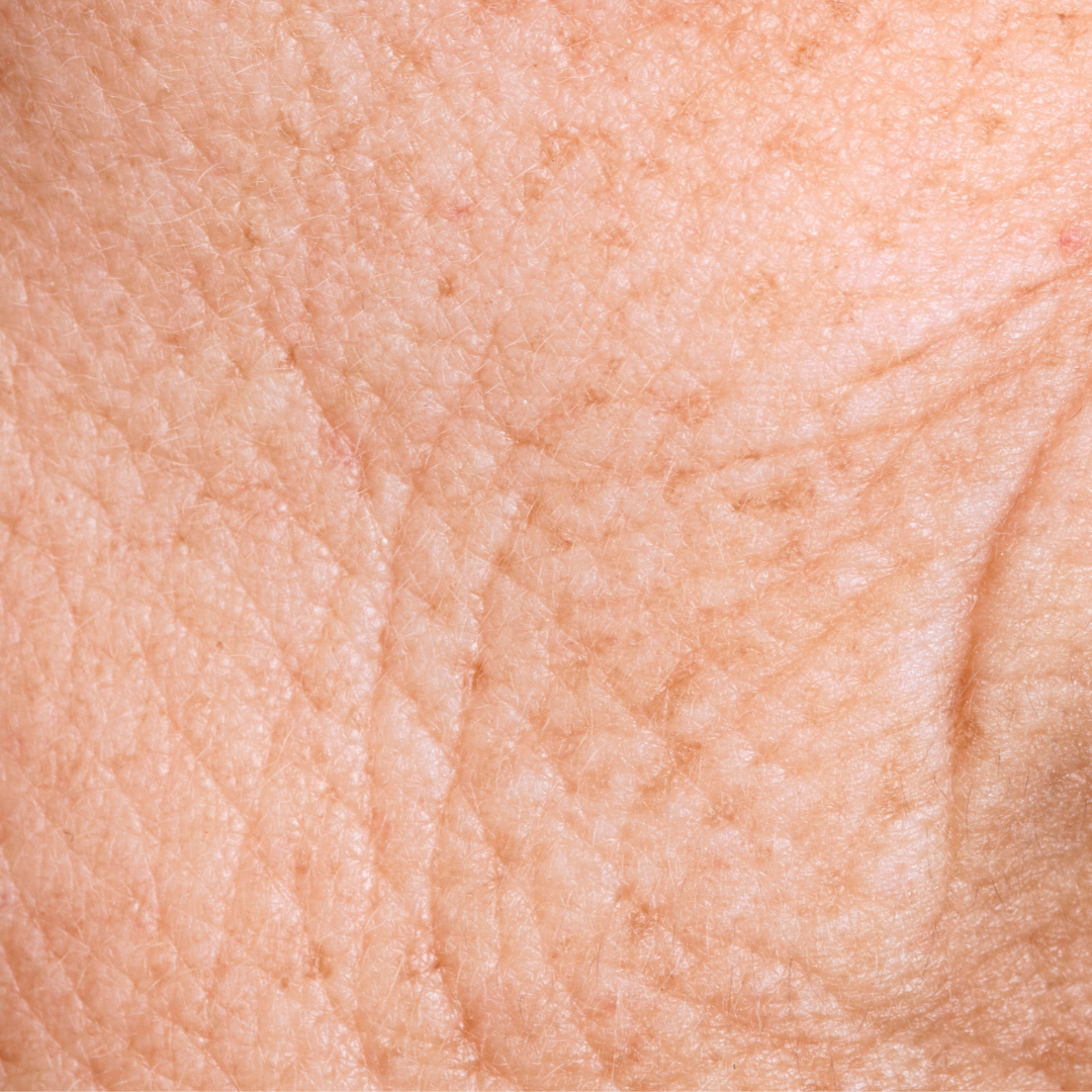 fine lines/ wrinkles