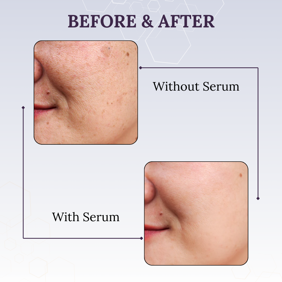 Skinaa 10% Niacinamide Face Serum | Acne Control & Pore Minimizing Serum for Clear Skin | 30 ml