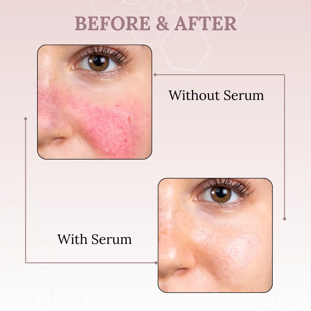 Skinaa 10% Azelaic Acid Serum | Pigmentation & Acne Control | 30 ml