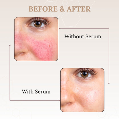 Skinaa 10% Azelaic Acid Serum | Pigmentation & Acne Control | 30 ml