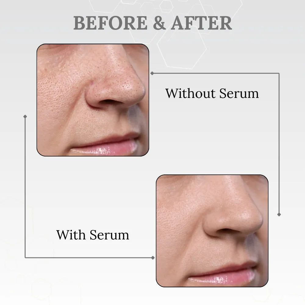 Skinaa AHA BHA PHA Gentle Exfoliating Serum | Acne & Blackhead Control | 30 ml