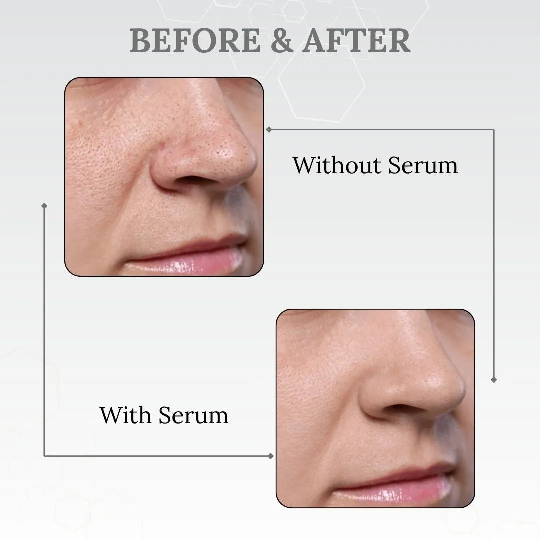 Skinaa AHA BHA PHA Gentle Exfoliating Serum | Acne & Blackhead Control | 30 ml