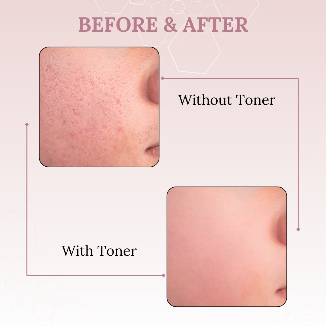 Skinaa Anti-Acne Toner with Witch Hazel & Glycolic Acid 100ml
