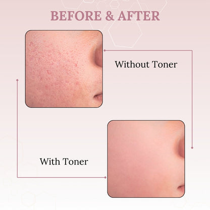 Skinaa Anti-Acne Toner with Witch Hazel & Glycolic Acid 100ml