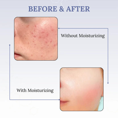 Skinaa Gel Moisturizer for Oily Skin | Niacinamide Hydrating Gel for Acne & Pore Control | 100 ml