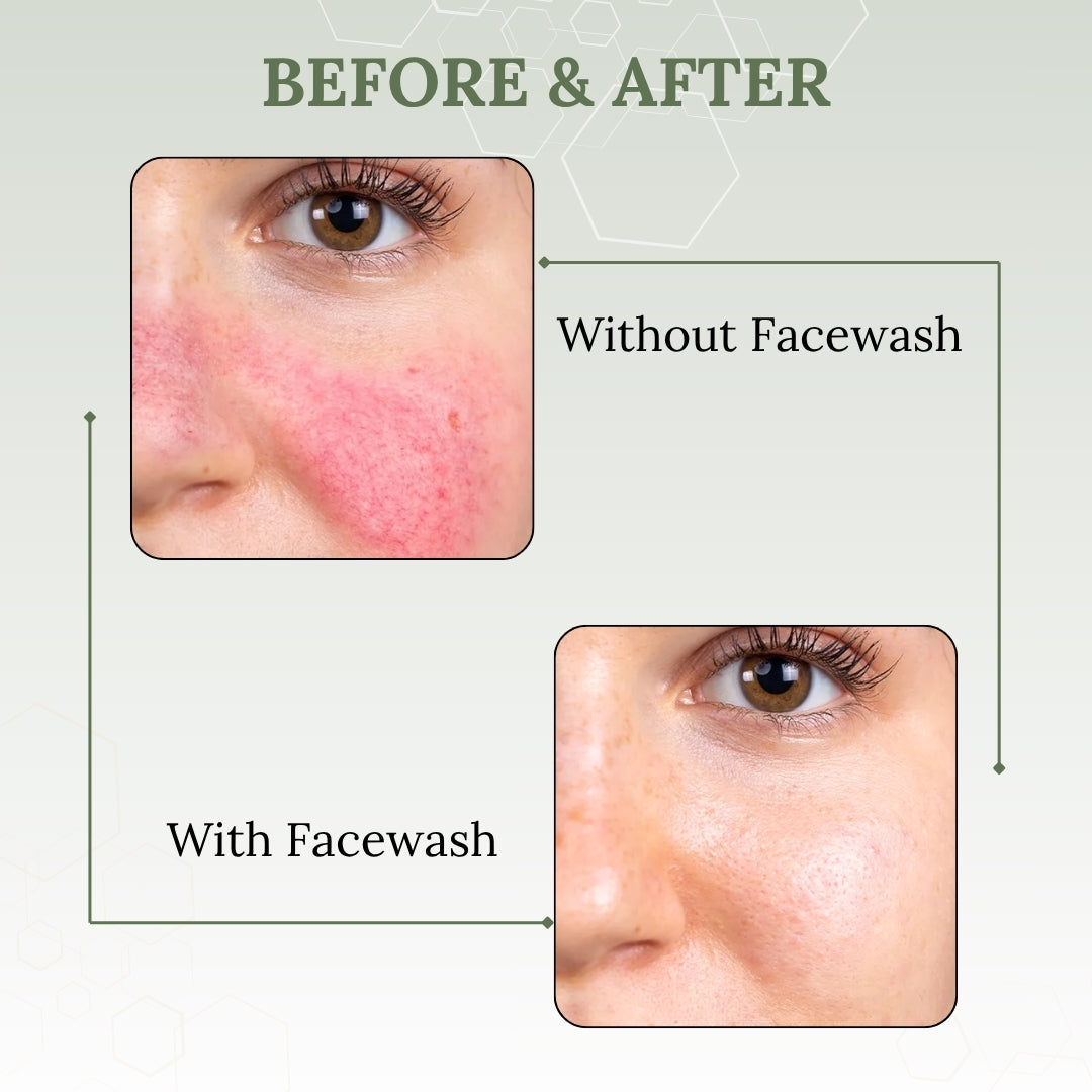 Before and after comparison of a person's face with and without Skinaa Anti Acne facewash on a light green background.
