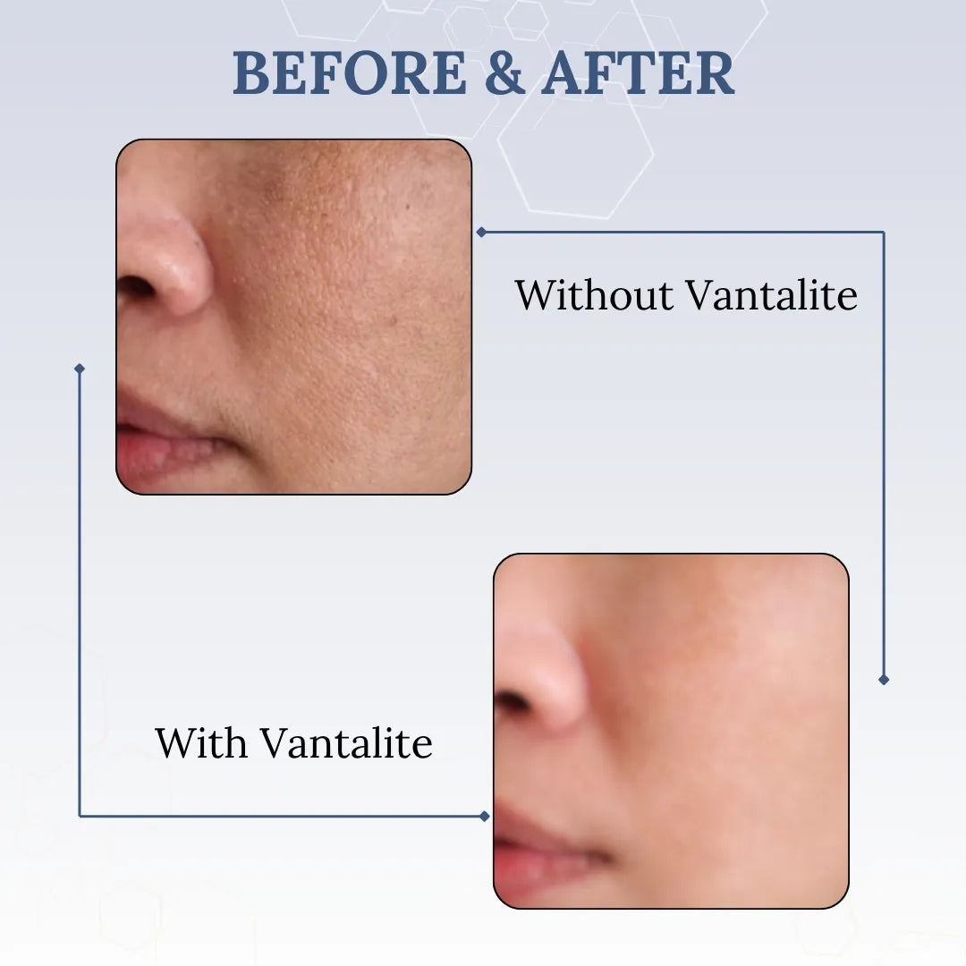 Before and after comparison of skin treatment with Vantalite on a light blue background.